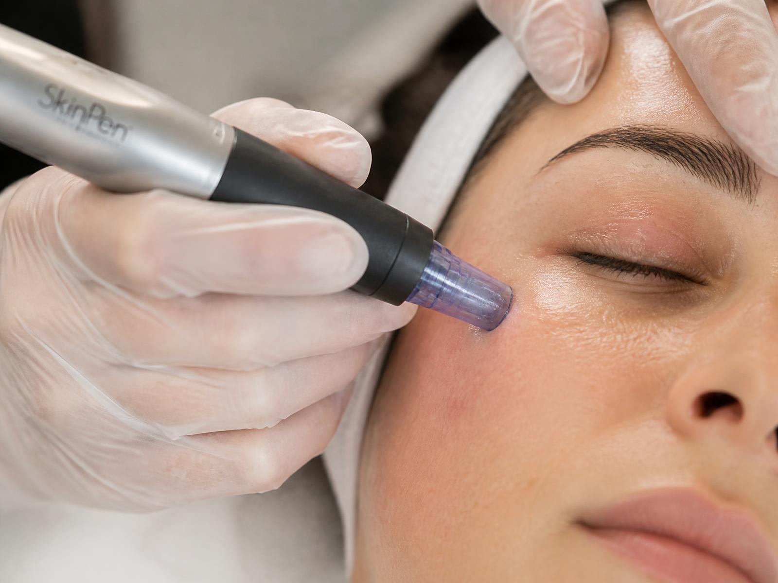 Enhanced microneedling performed with precision