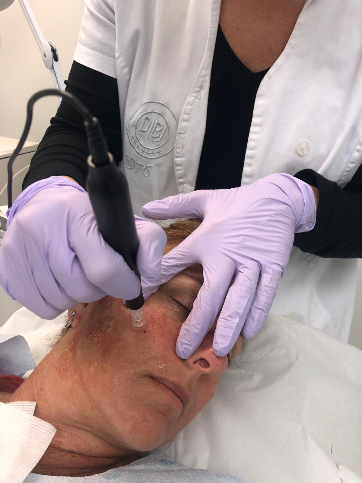 Microneedling work refining skin texture and pores