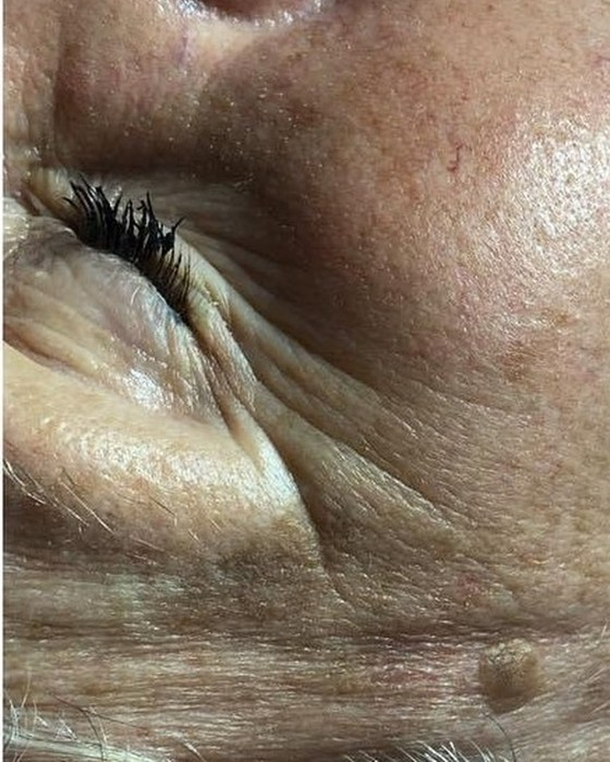 Before client's eye area, firmness and fine line progress