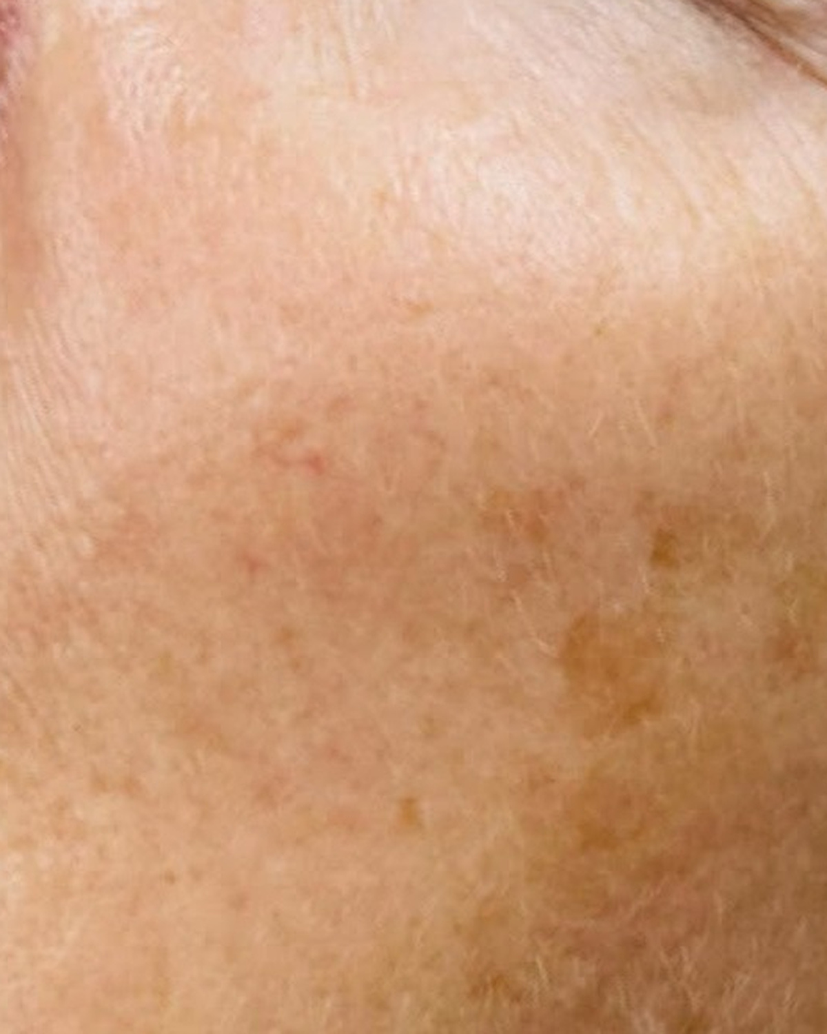 Before client's cheek, tone and pigment progress