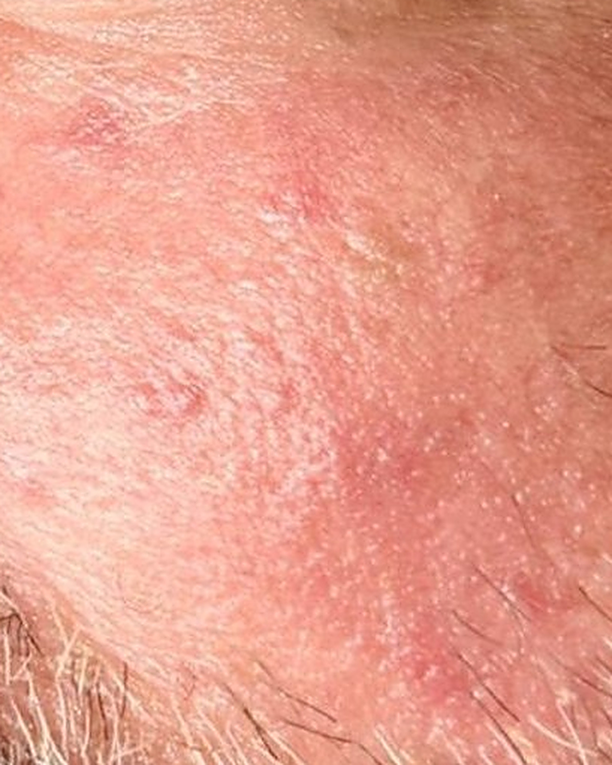 After client's cheek, redness and sensitivity progress